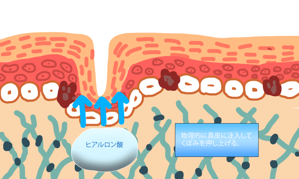 ヒアルロン酸注射のイメージ